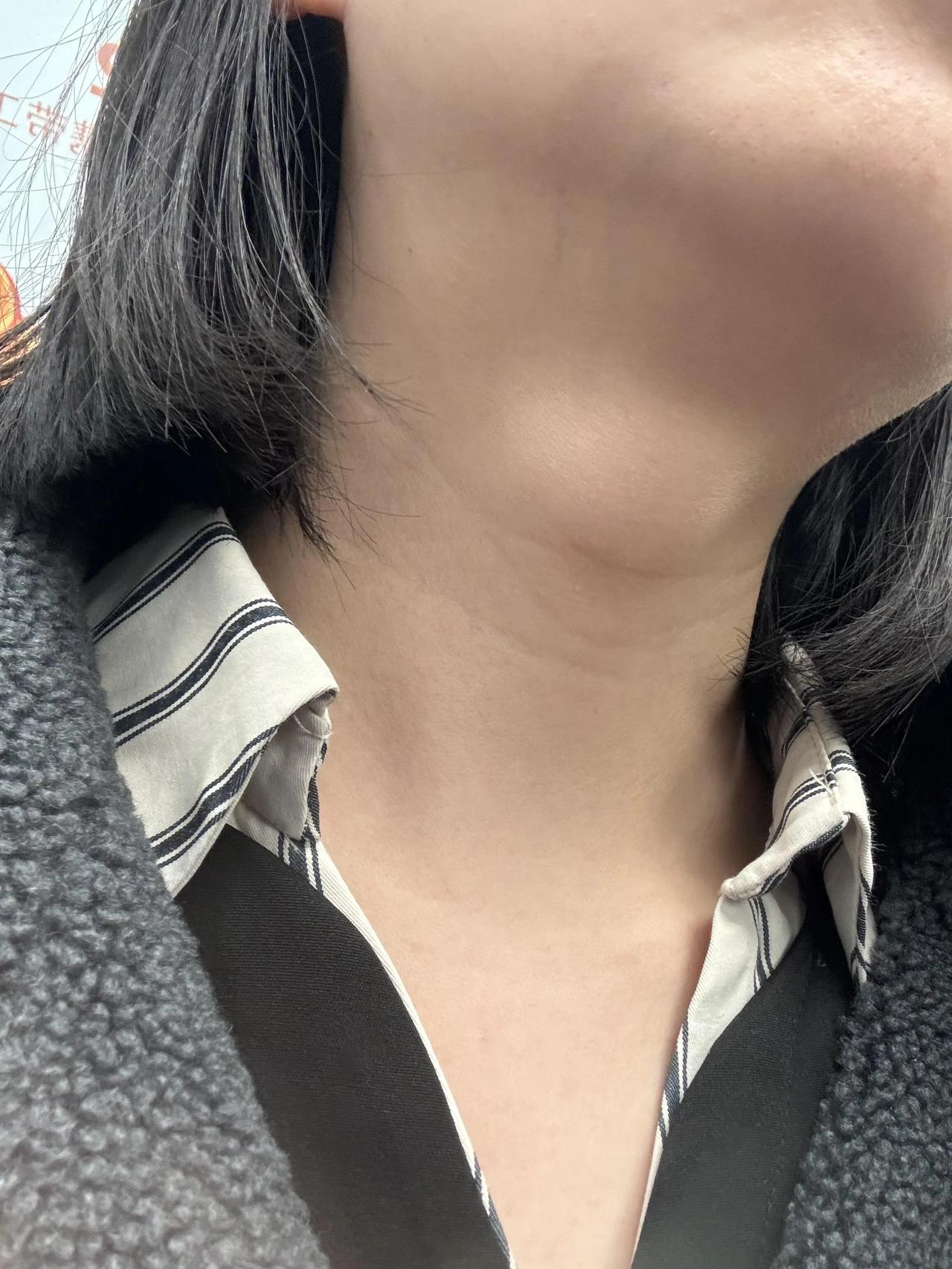 一直以为喉结比普通女人大，没想到是囊肿这个肿大持续了伴随了很多年了，感觉关注到