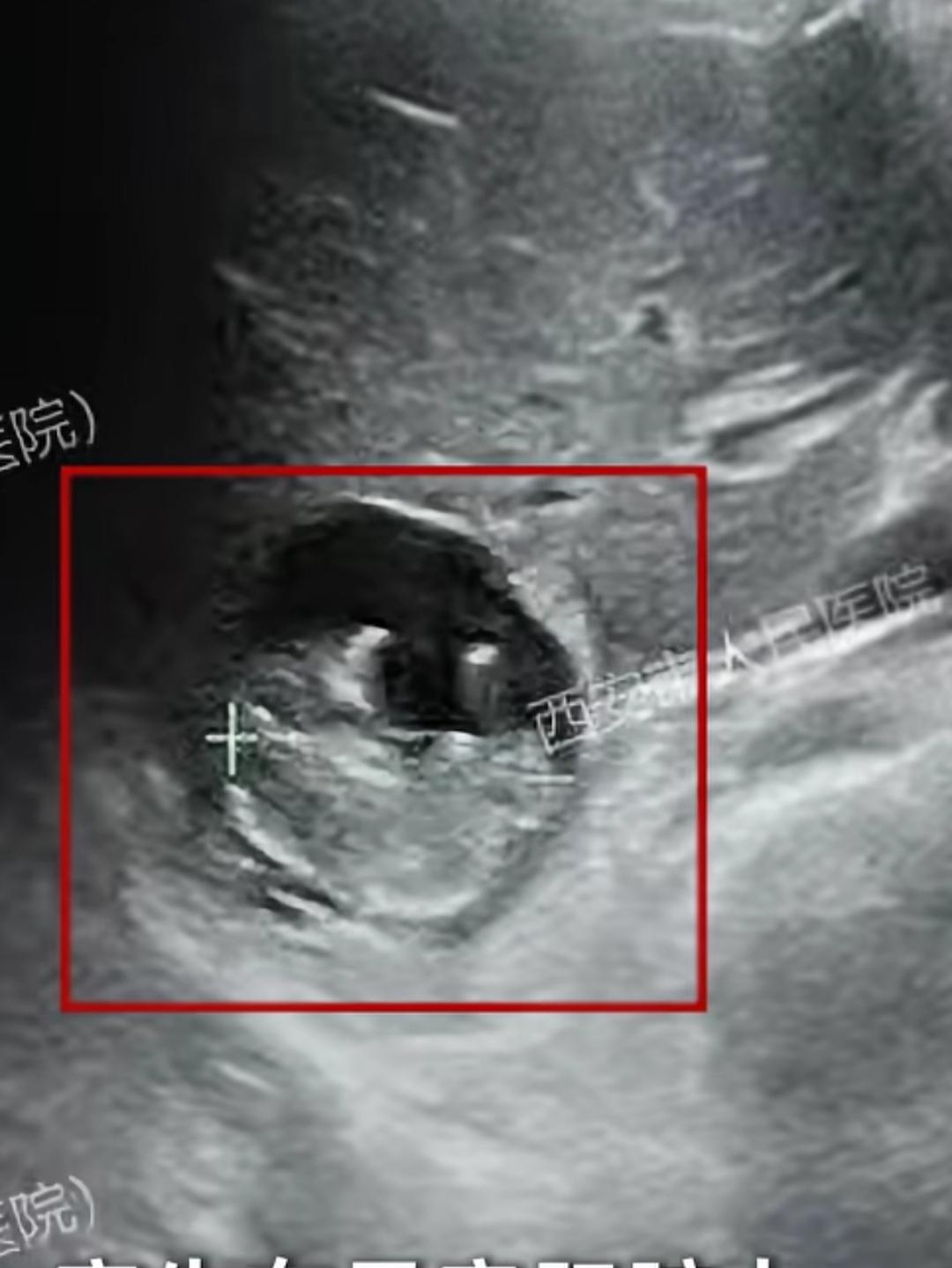 “心肝宝贝”就是这么来的！近日，50岁的王女士抽血检查后发现自己怀孕了。然而