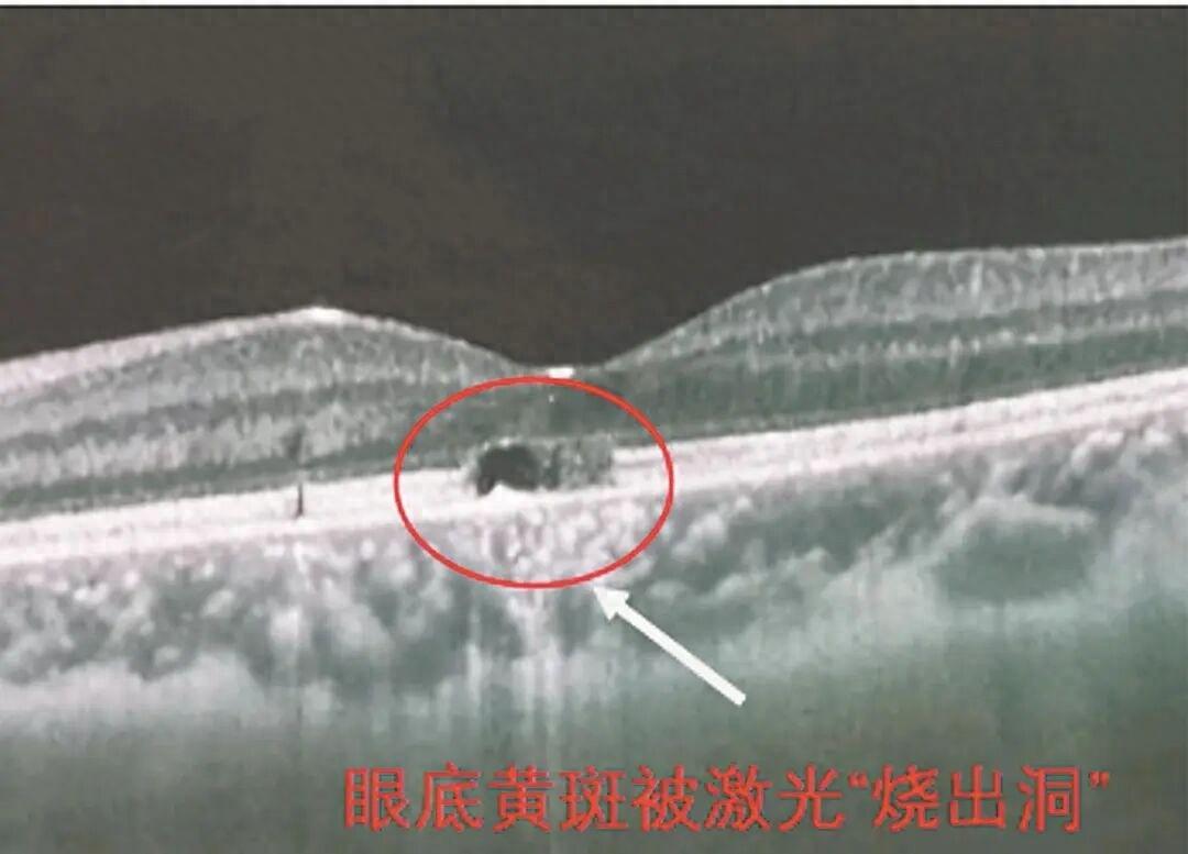 “悲剧还是发生了！”福建，8岁男孩和同学玩耍时，不小心被同学用激光笔照了一下眼睛