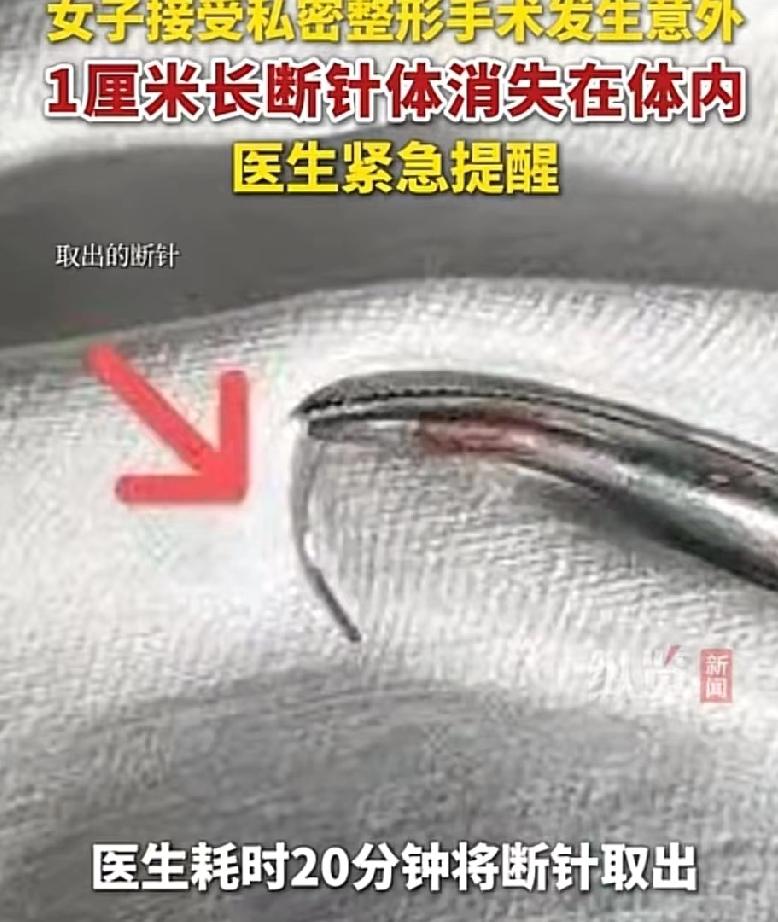 浙江一女子做私密手术，缝合针断在身体里，最后靠大医院才取出。手术台上针“咔哒