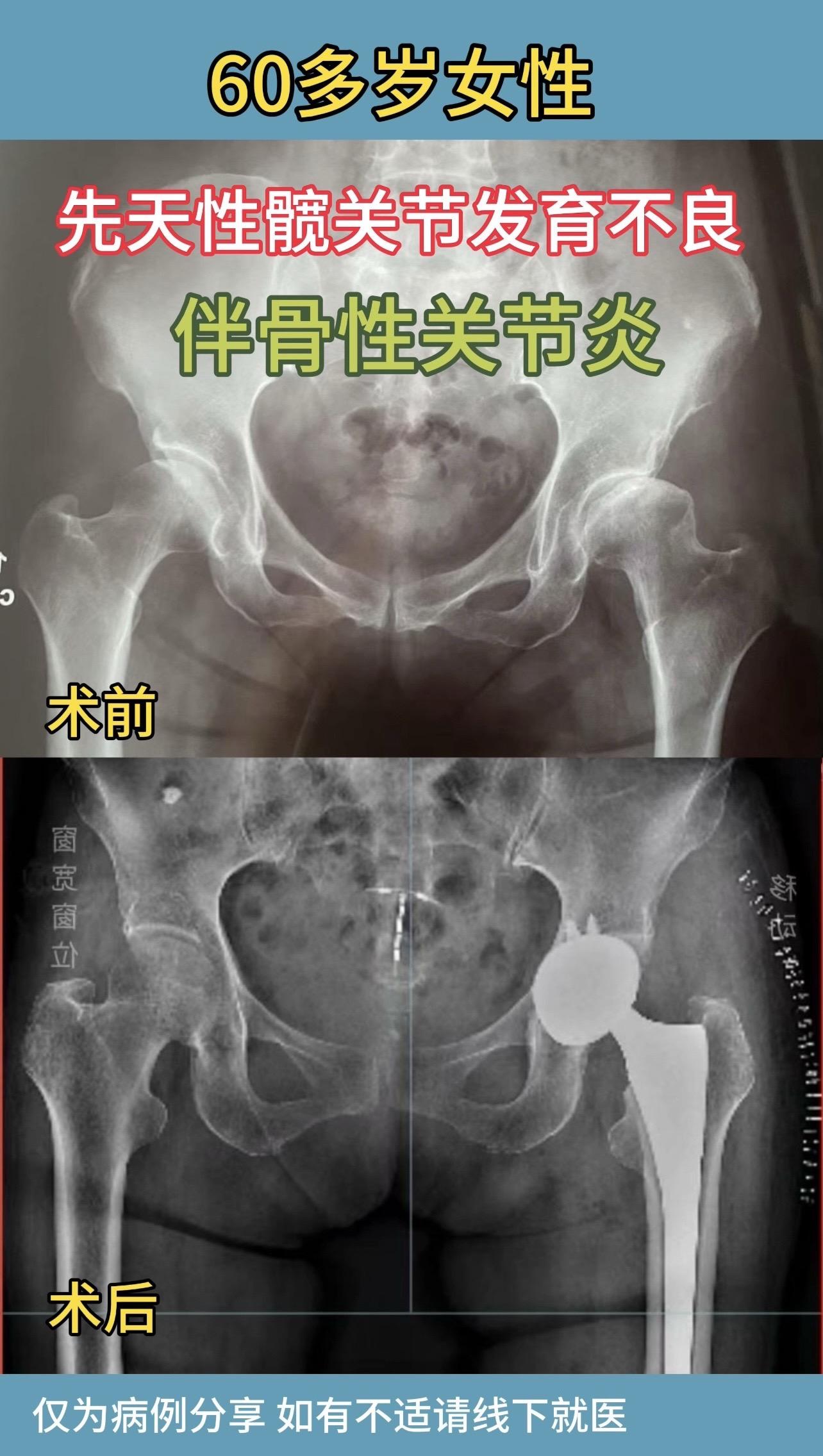 60多岁女性，右腿疼痛2年，加重2月，在当地按腰突治疗效果欠佳，经仔细...