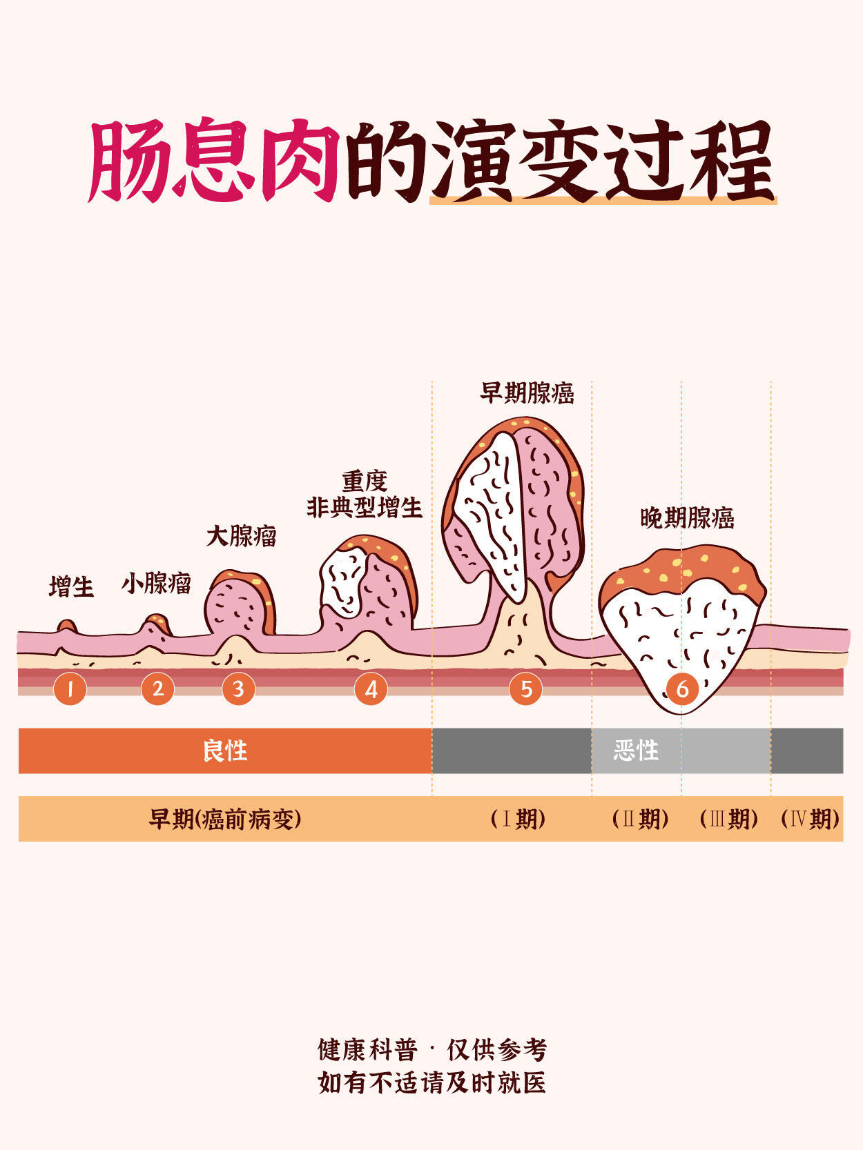 从息肉到肠癌仅4步肠息肉并非都会癌变，但腺瘤性息肉会经历“增生→腺瘤→非典型