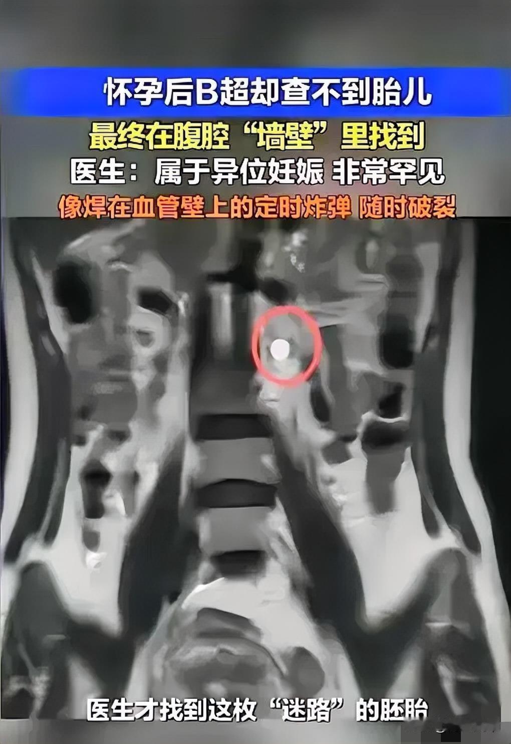 “太惊险了！”5月7日报道，广东深圳，一女子用验孕棒发现自己怀了，她赶紧去了医院