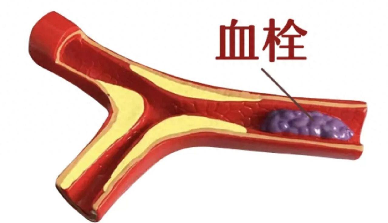 比肥肉毒10倍！这“补血补脑”的菜，很多人天天吃，血管早堵成“淤泥管”家人