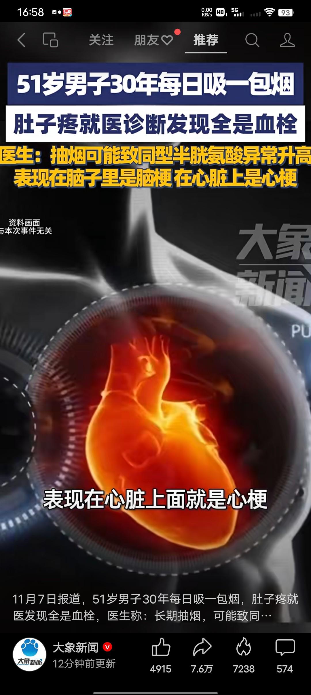 吸烟有害健康都知道，吸烟也会导致血栓形成有人知道吗？51岁男子30年每日吸一包