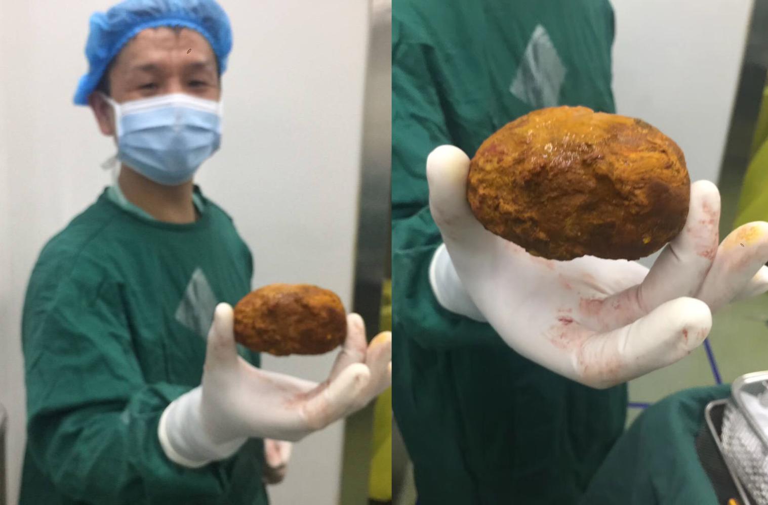 老人腹痛如刀绞 胆管中取出“红薯”般大结石 医生: 确实罕见!