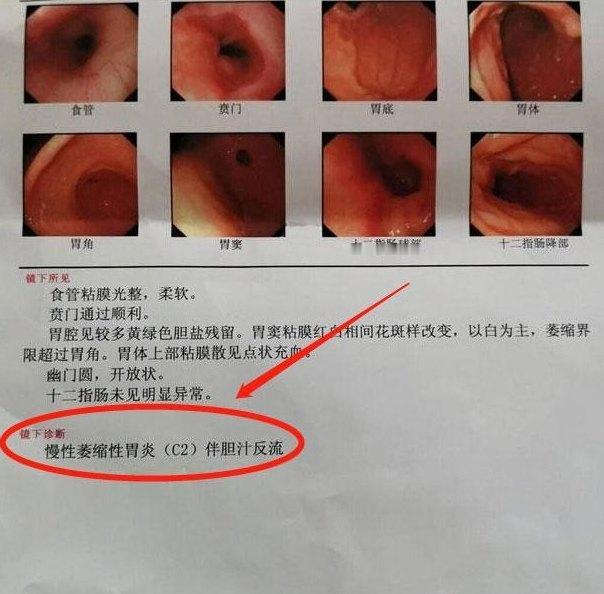 胃不好的朋友们注意啦！不管是慢性浅表性胃炎、反流性食管炎，还是萎缩性胃炎、糜烂性