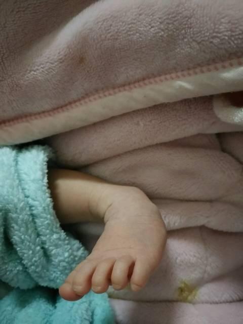 孕期没做最重要的大排畸孕检, 生出足内翻宝宝你就后悔了