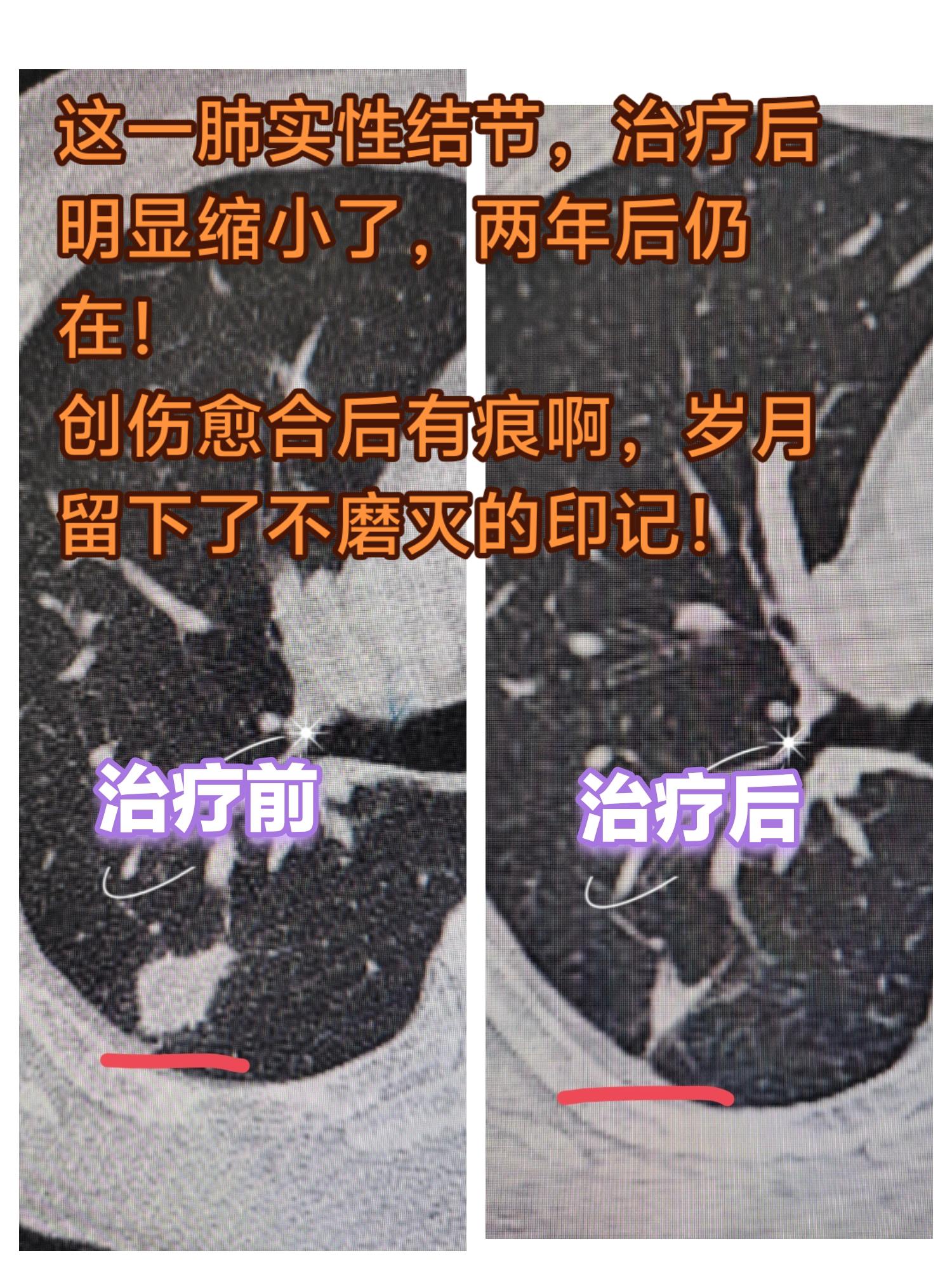 肺结节治疗后留下了疤痕。肺实性结节，治疗后明显缩小了，两年后仍在！ 创...