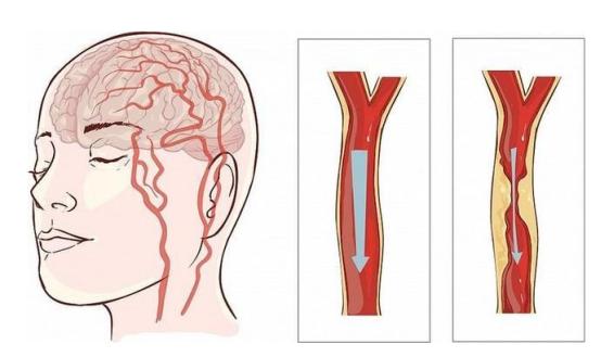 为何中国脑梗越来越多？提醒：离不开这2个祸根，不是叶酸补少了中国脑梗患者已