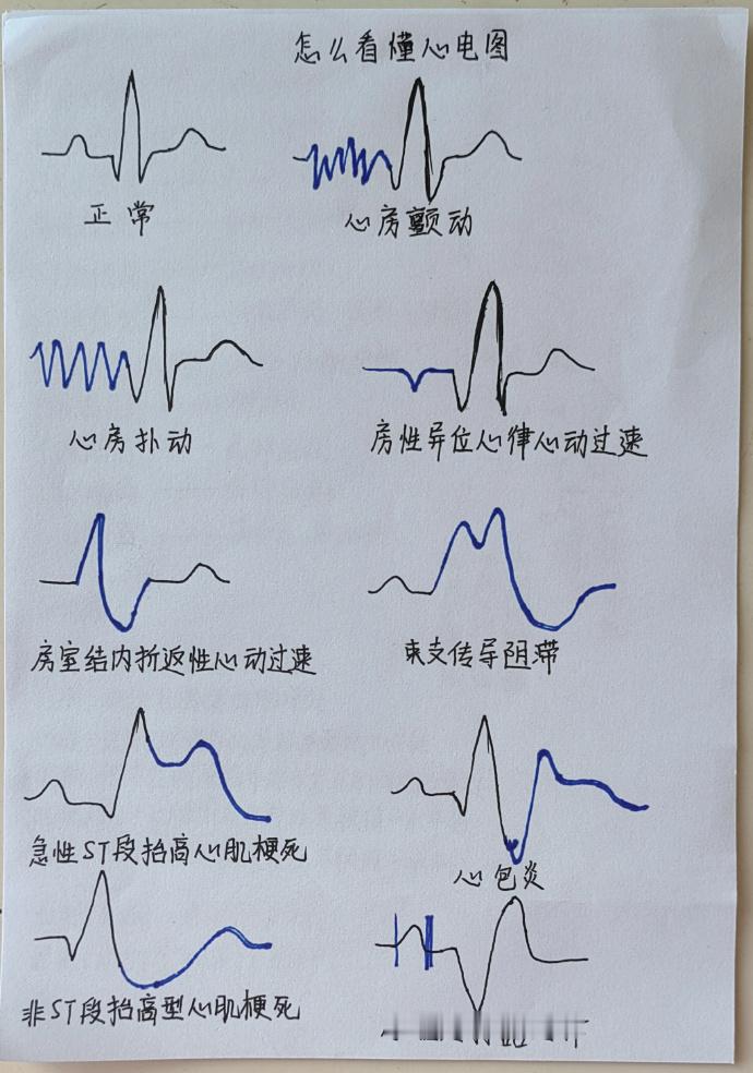 终于有人把心电图怎么看懂讲清楚了​​​