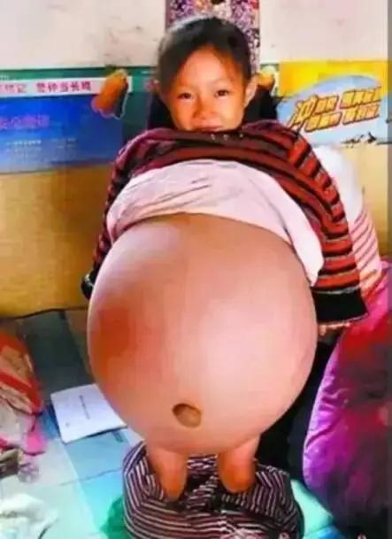 山西4岁女孩小云星腹大如孕，多家医生预言她活不过三个月，绝境之际，房东大姐随口一