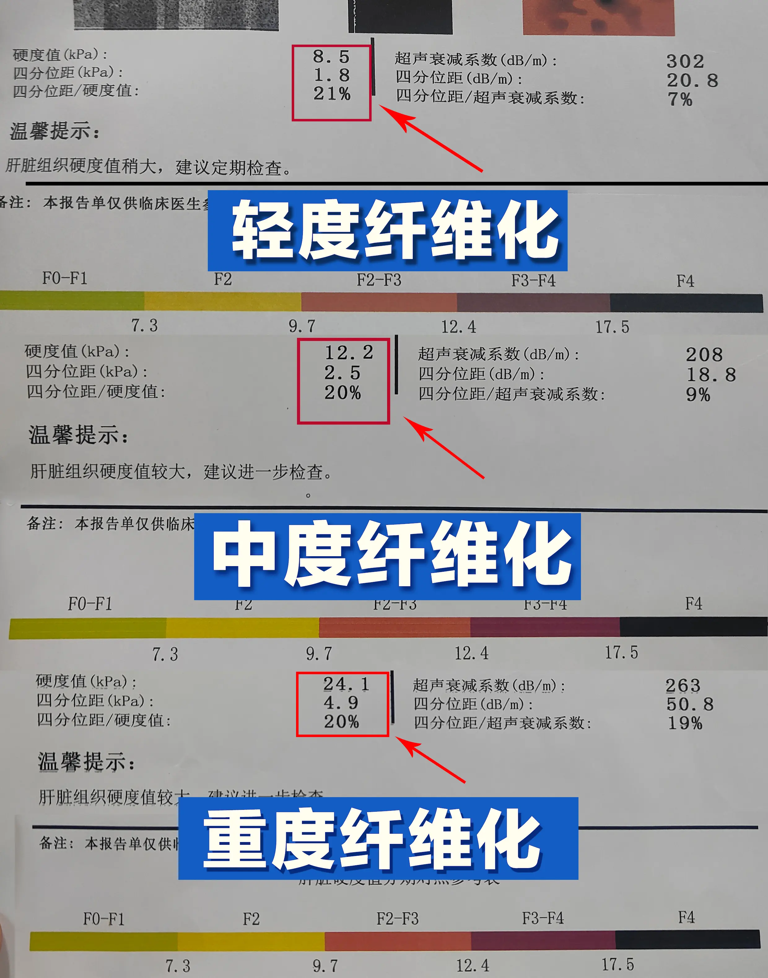 肝纤维化是肝脏长期受损后的瘢痕修复过程，按轻重可分为4期。F2期:7....