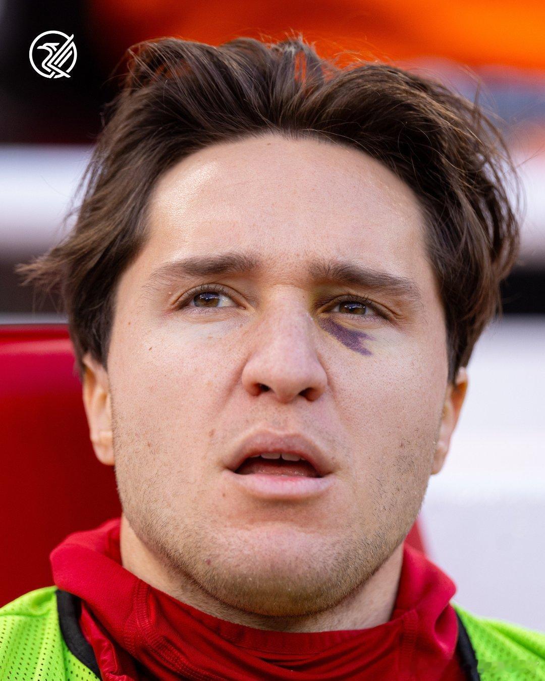 基耶萨的眼睛下面都是淤血