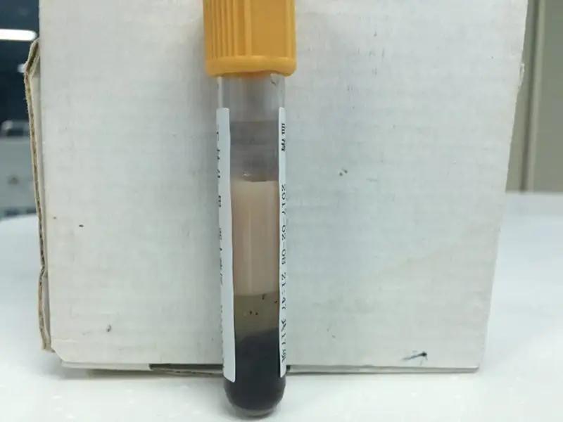 32岁姑娘血管里抽出“黄油”！医生一句话，让全国年轻人集体放下奶茶杯1️⃣