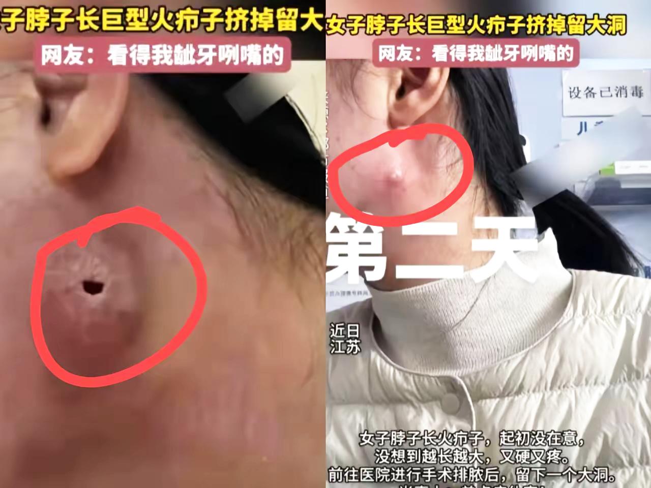 家人们！江苏姑娘挤火疖子挤出水泡还留大洞的事儿看完真的浑身一紧！谁能想