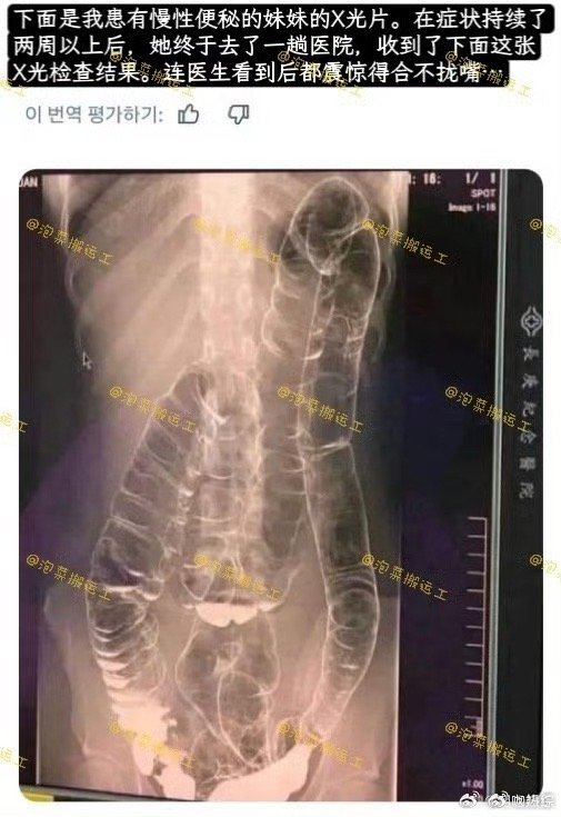 便秘两周的人的X光检查结果长达两周排便不畅，拍片结果直观反映出体内堆积的状况便秘