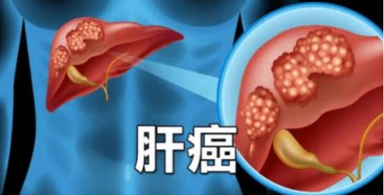 什么样的人最容易得肝癌，这几类人一定要小心 很多人以为肝癌只盯着酗酒的人，滴