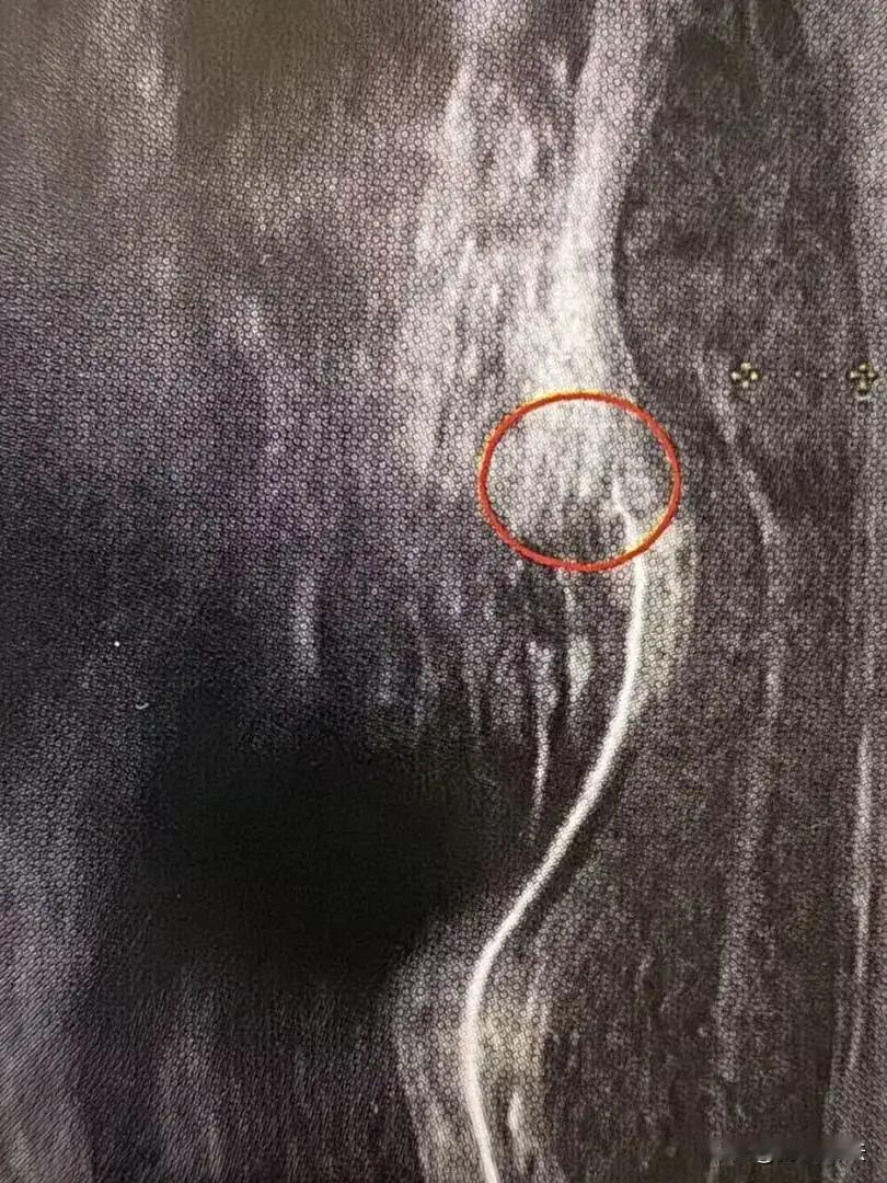 男人逞强的代价！浙江杭州，一49岁男子不服老，跟老婆亲密时，动作用力过猛，突然“