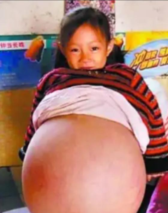 2010年，山西4岁女孩胡云星，肚子超大鼓胀得像孕妇。医生预言活不过三个月，就在