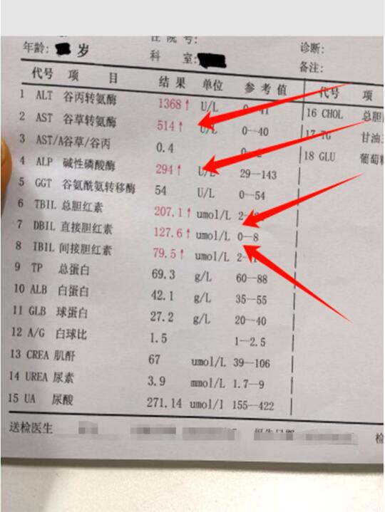 又是一例肝硬化，不应该犯这个错！ 这是一位山东寿光43岁患者，肝功能检...