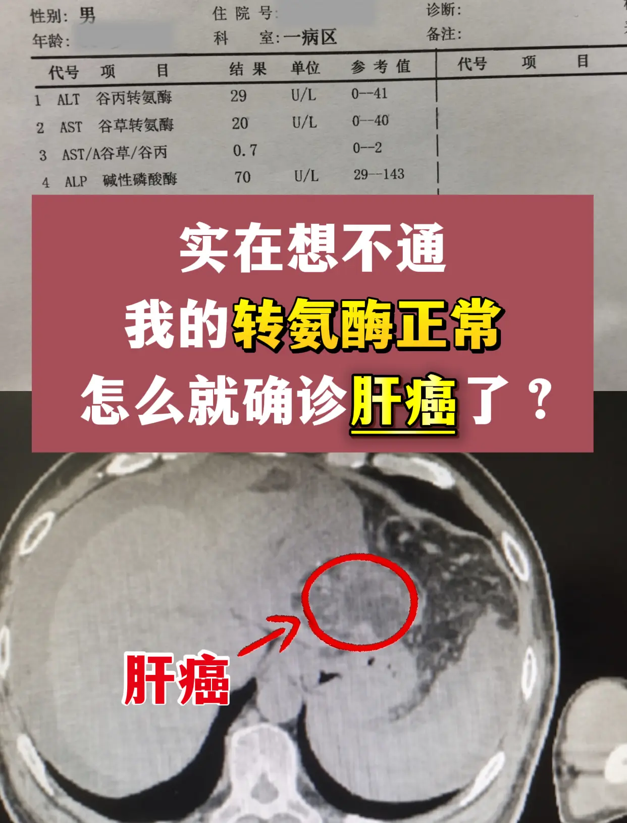 前段时间接诊一位山东男士，知道自己有乙肝病史，前年复查肝功能的时候看到...
