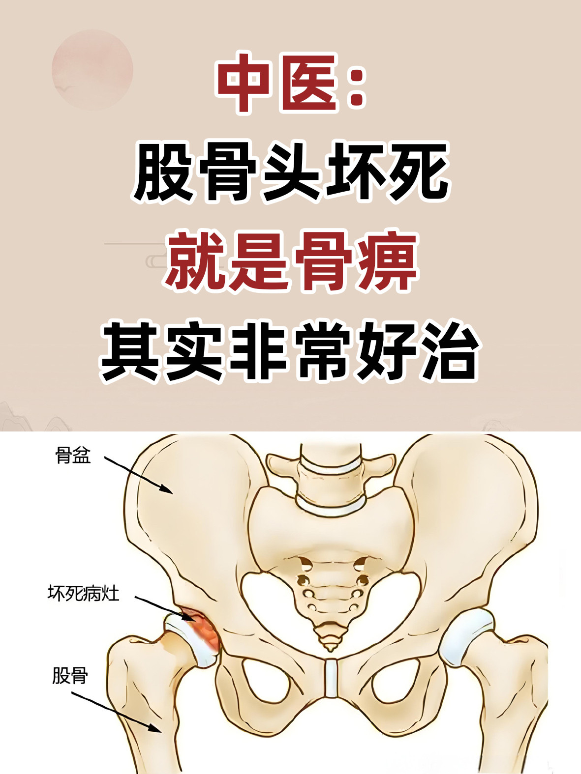 刘欢曾患股骨头坏死，这是什么病？刘欢去世的消息传来后，他过去的健康经历也再次受到关注，其中一个被反复