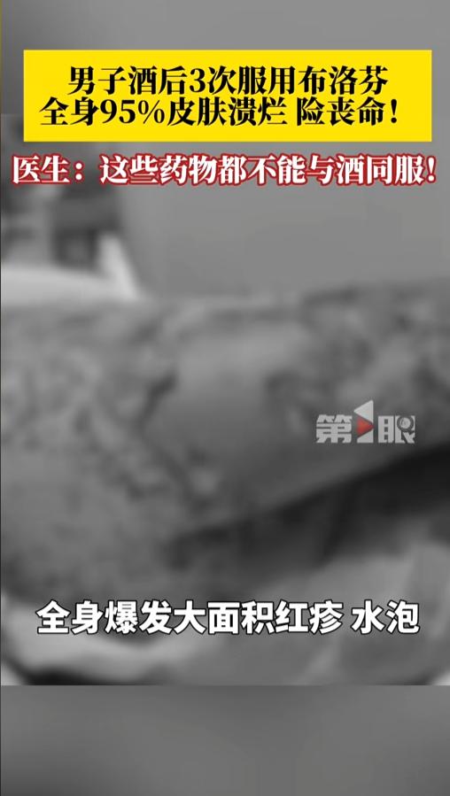 “悲剧还是发生了！”4月27日报道，陕西，一男子饮酒后受凉发烧，就服用了布洛芬悬