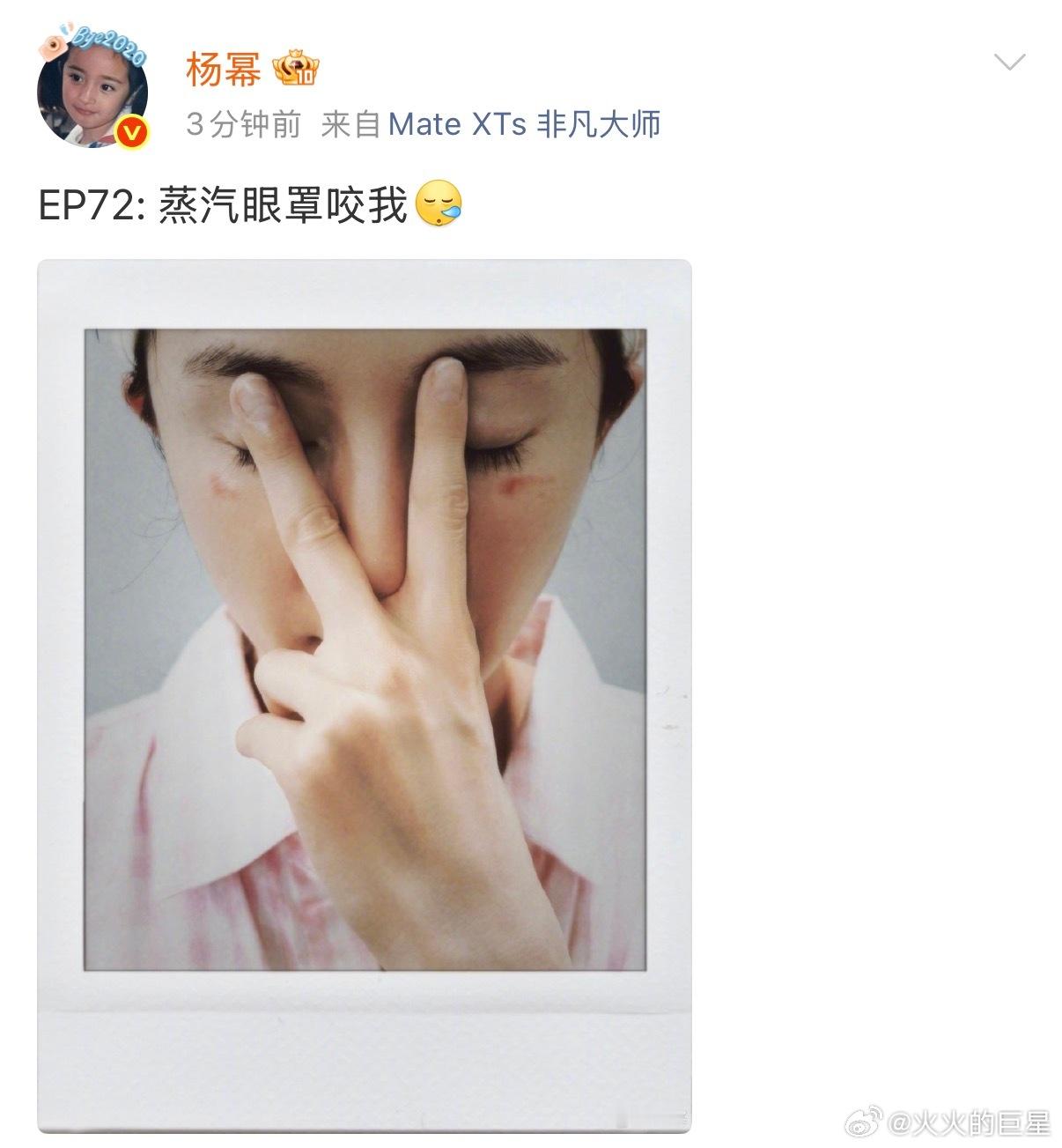 蒸汽眼罩怎么还咬人杨幂脸被蒸汽眼罩烫伤了杨幂说蒸汽眼罩咬我