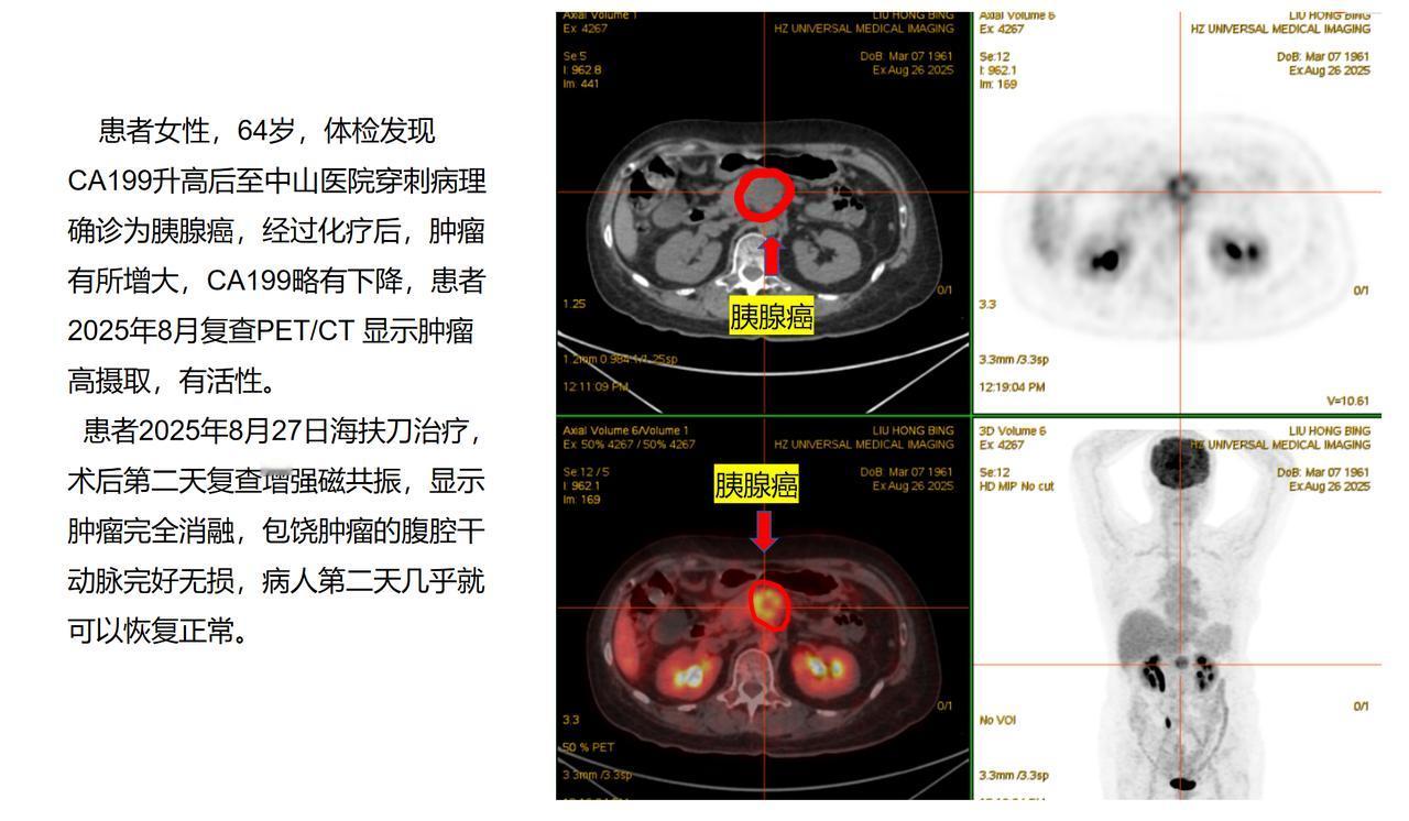 这是我们昨天才海扶刀治疗的一名晚期胰腺癌患者，病人64岁，女性，来自上海，患者今