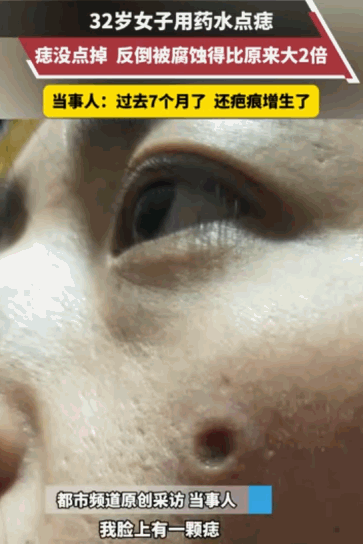 “不要什么东西都往脸上招呼。”据媒体5月21日报道，一位32岁的女士本想祛除一颗