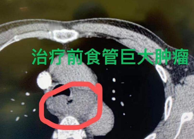 一种具有“中国特色”的癌症——食管癌，在我国的发病率格外引人关注。全球近一半的食