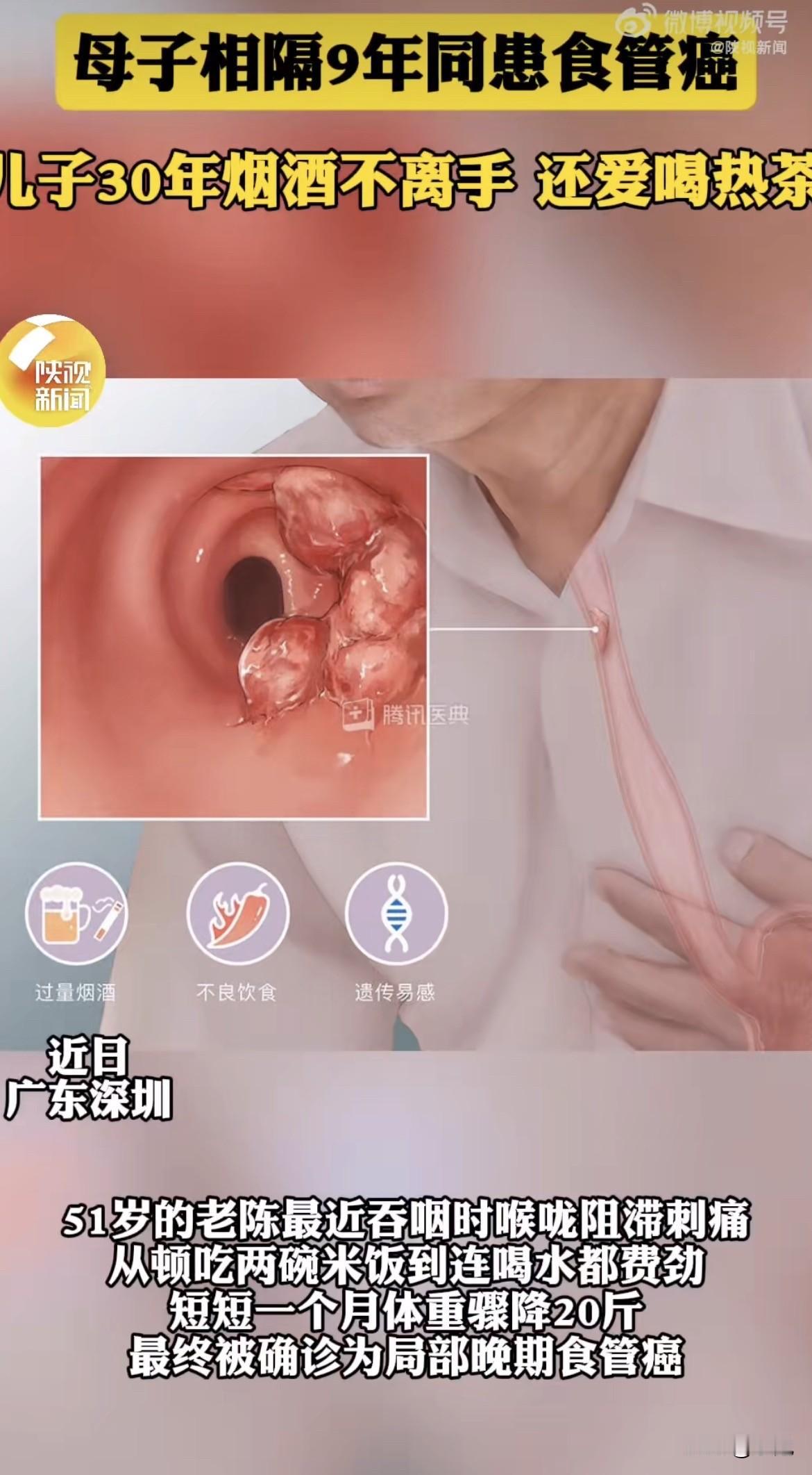 深圳的老陈，在确诊为局部晚期食管癌的那一刻，脑海里闪过的，是9年前母亲被同一种病