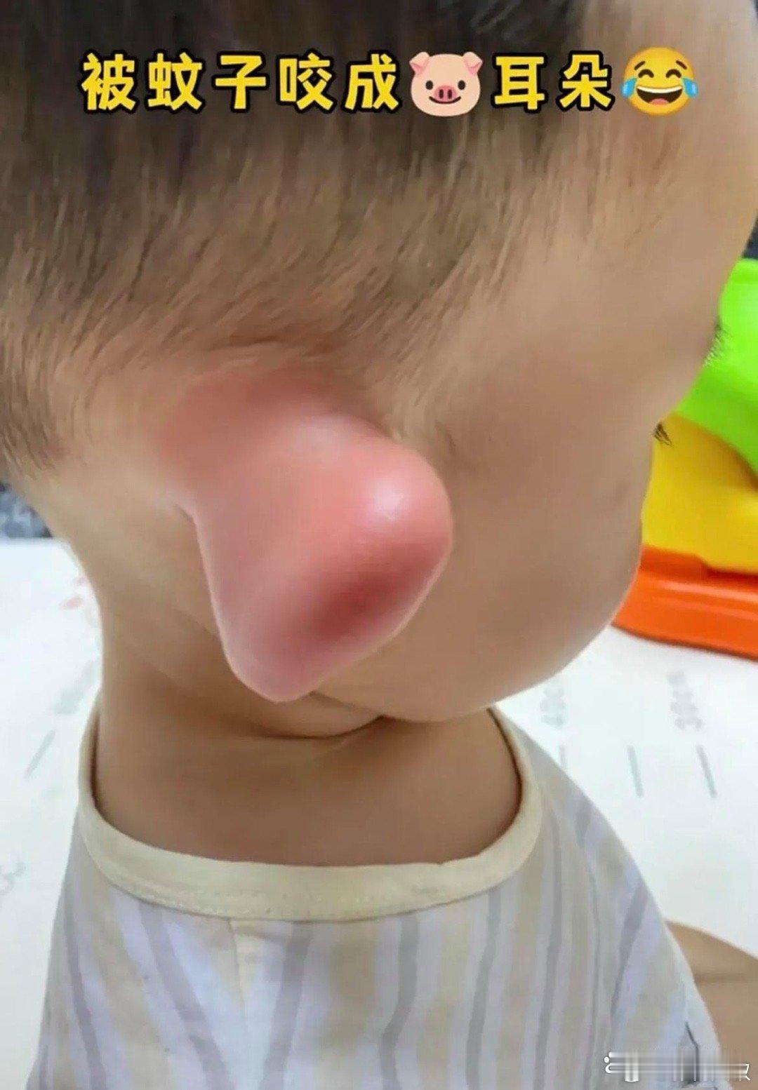 被蚊子咬成猪耳朵了​​​