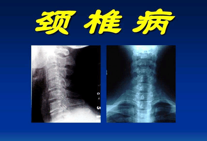 现在看还不晚 这样穿衣服容易得颈椎病