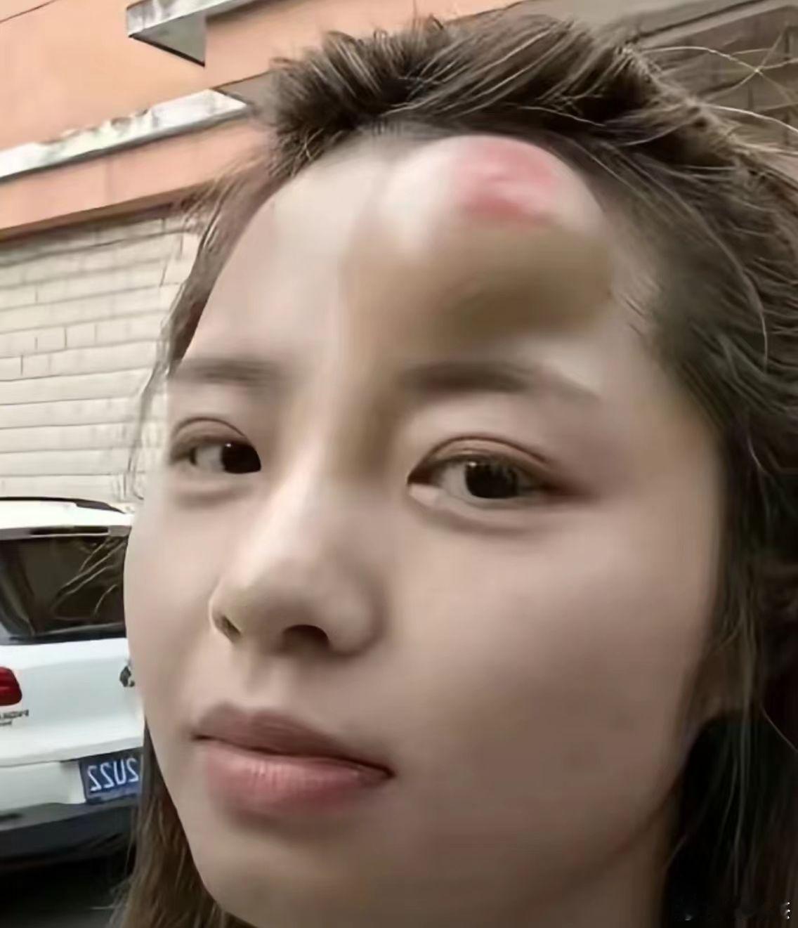 额头上的这个包，要多久才能消除？​​​