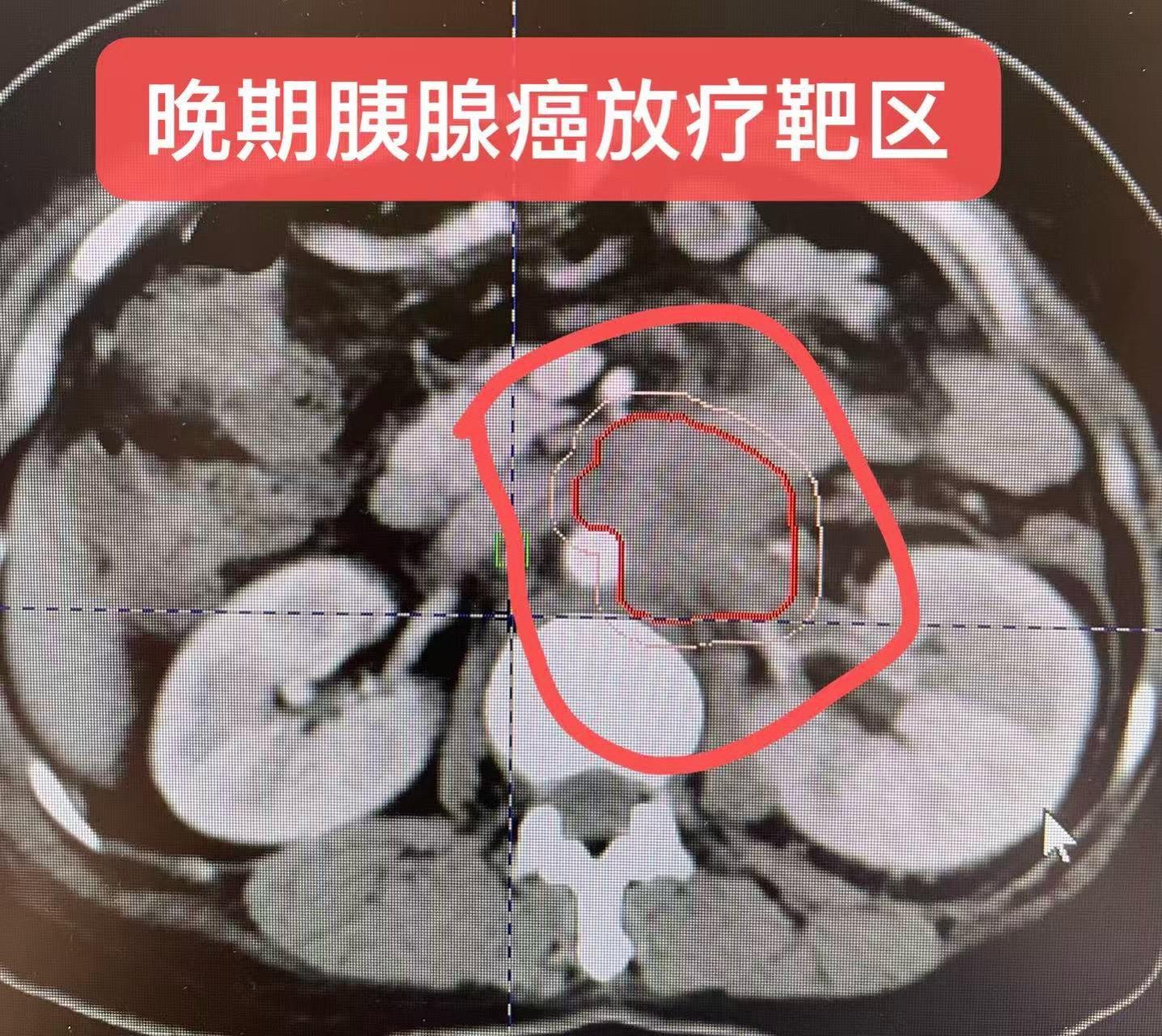不可手术的晚期-胰腺癌治疗。女患者，晚期，不可手术，经超声胃镜活检：明...