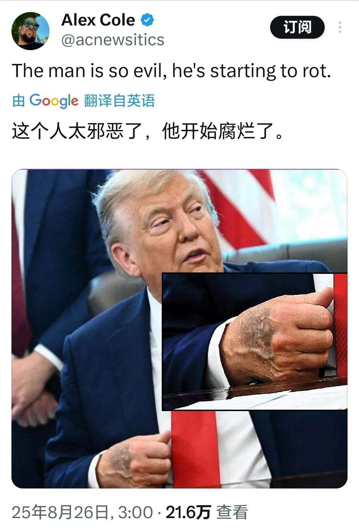 特朗普被拍到手背腐烂，健康状况遭到质疑，今年已经79岁的特朗普之前被记者发现手上