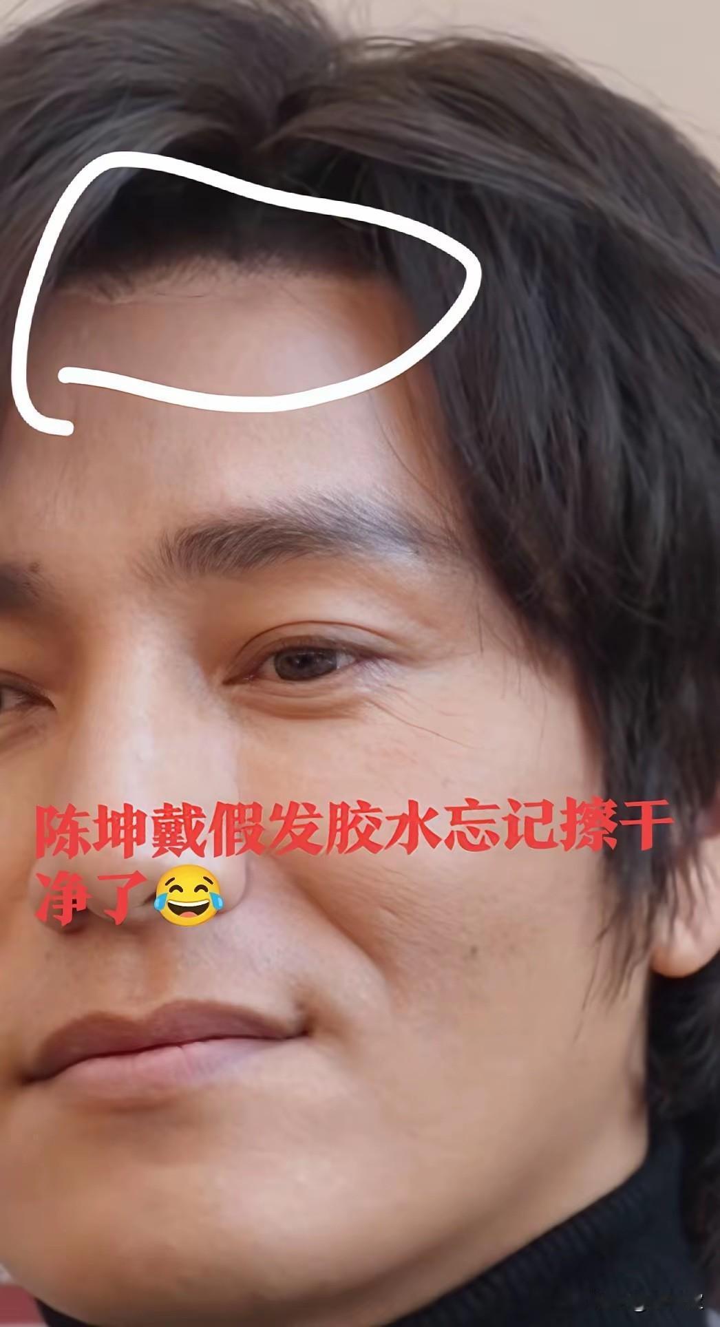 搞不懂现在植发这么方便为啥男明星还要戴假发呢？这届网友真的都是拿放大镜上网