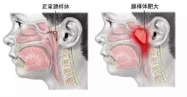 宝宝张嘴睡觉、打呼噜, 不是孩子睡的香, 可能是病, 得治!