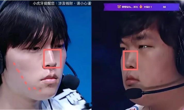 网友细扒Bin脸部变化细节：鼻梁变直变长；脸颊软组织折叠变化！！网友发帖，细扒B