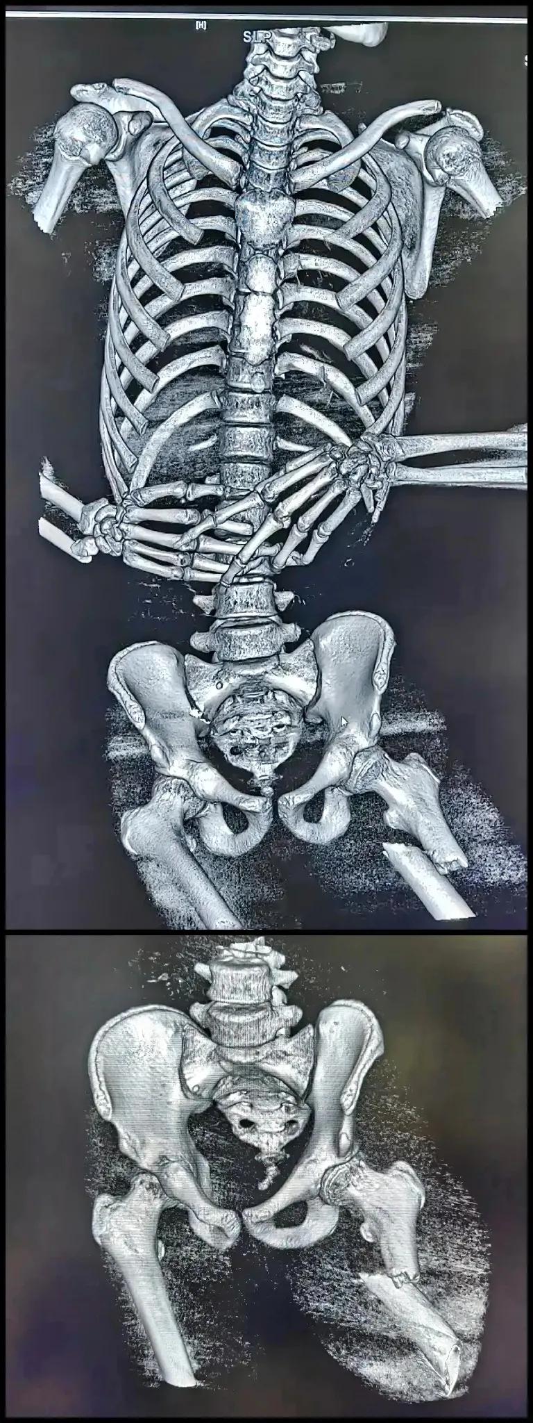 骨折！🌚这是车祸患者的CT片！虽然片子只显示骨骼，但通过左大腿股骨骨