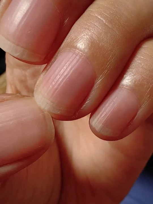 指甲上有竖棱代表肝血不足指甲出现竖棱、不够光滑，在中医看来多与肝血不足、气血偏弱