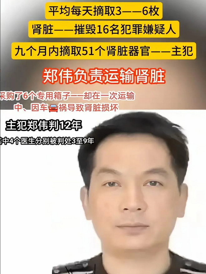 郑伟，2010年3月到12月，9个月摘取活体肾脏51例，获利超千万。被判有