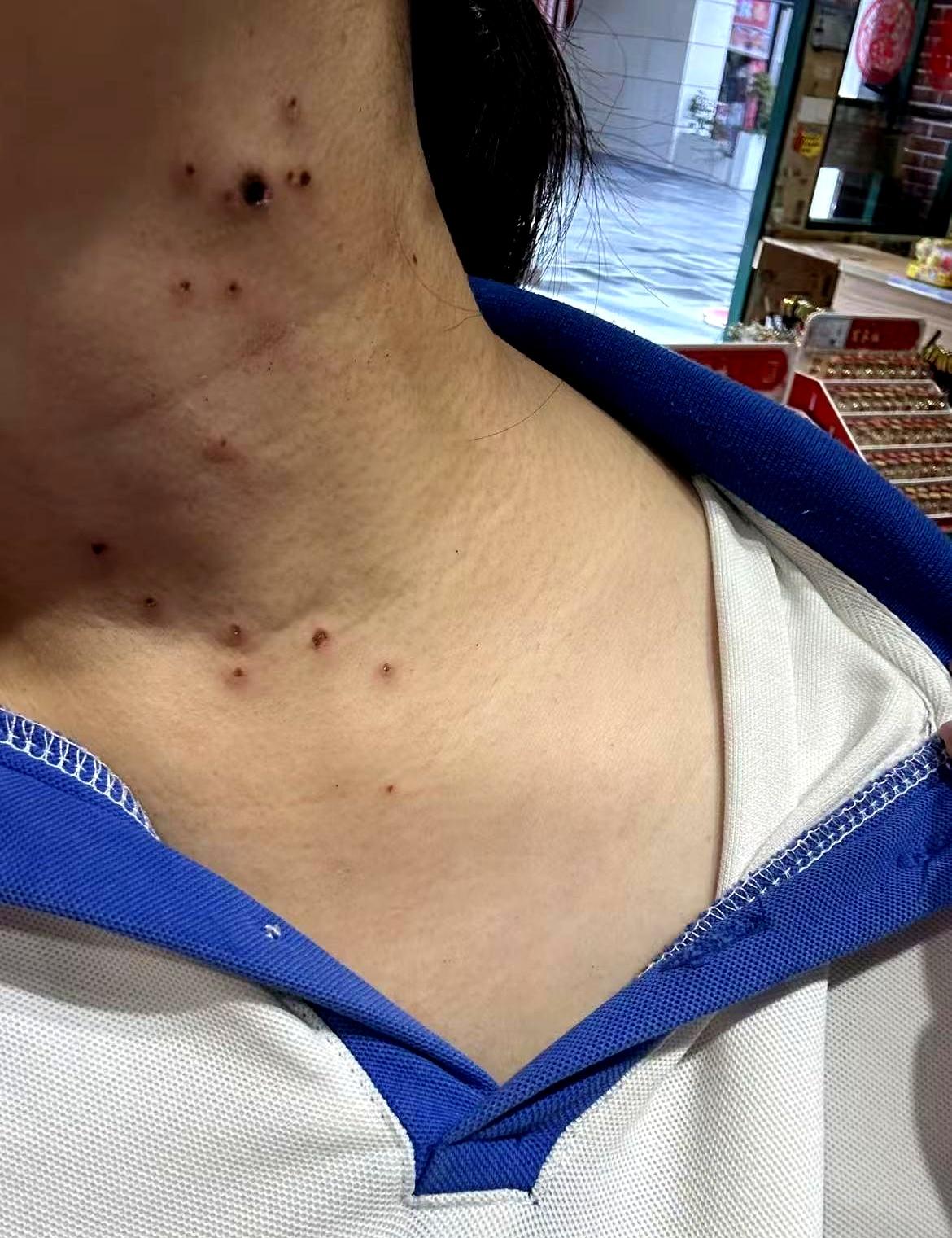 照镜子时那一刻，心里“咯噔”一下。脖子上那堆小疙瘩没消停，扁平尤、丝状尤，学会