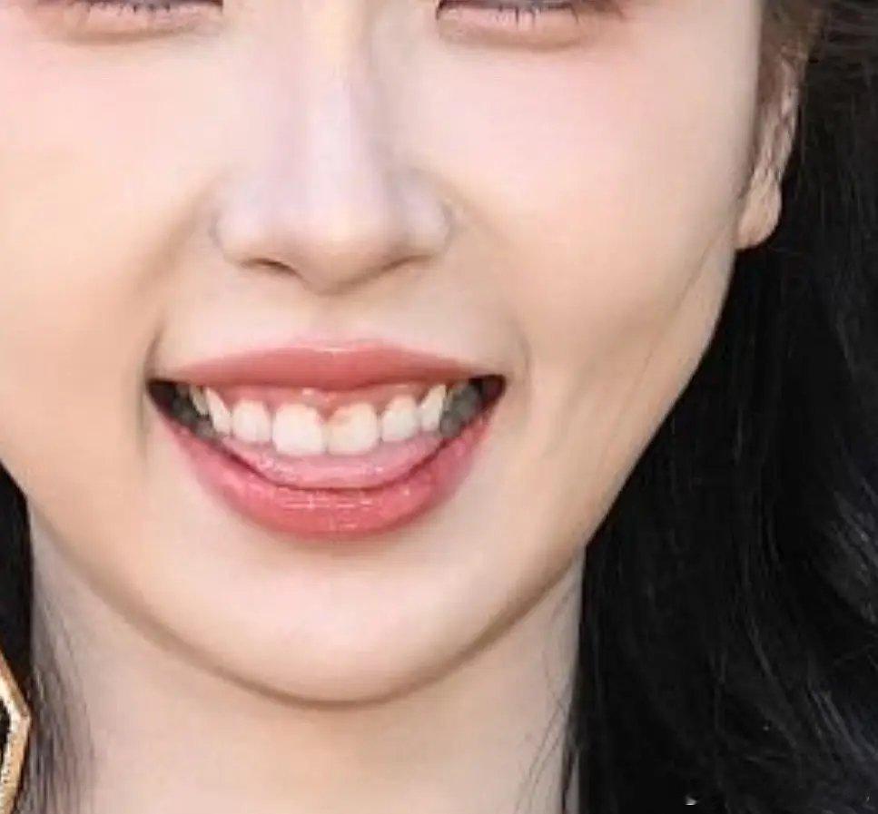 她左脸怎么了？医美失败了？