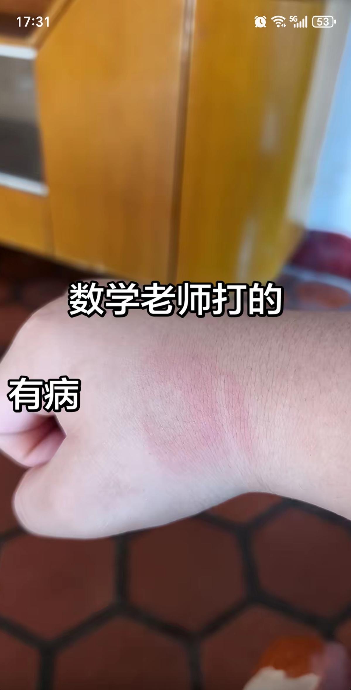 孩子在学校被老师打了手，这下炸锅了！看，孩子手背上有红印子，看起来并不严重，但