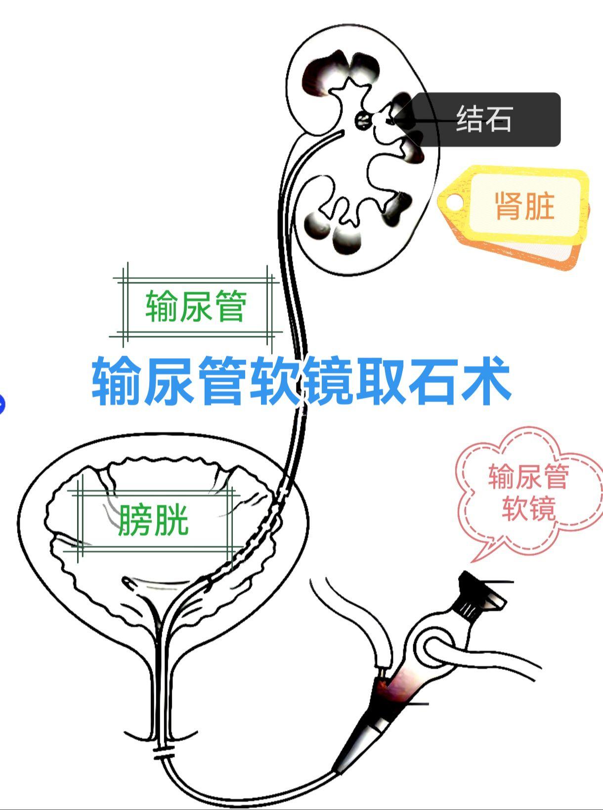 输尿管软镜取石术。