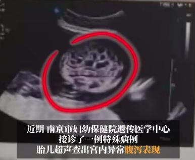 “太离奇了！”6月18日，江苏南京，一位29岁孕妈小文在孕24周+3天做常规产检