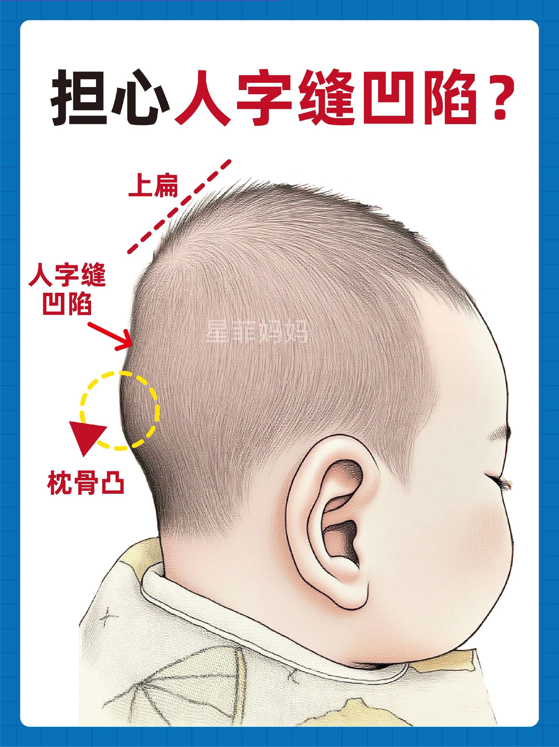 宝宝头型|仁💓字缝凹陷的看过来。